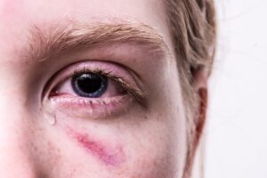 PP Violenza di genere - lividi